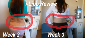 i-Lipo Reviews 4