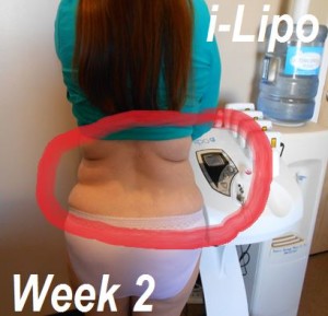 i lipo before and after pictures 2